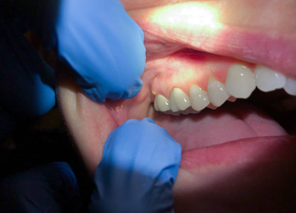 Best Broken or Chipped Tooth Repair in Wurtland, KY